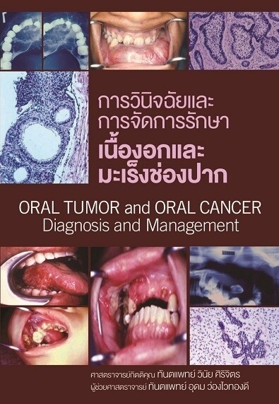 การวินิจฉัยและการจักการรักษาเนื้องอกและมะเร็งช่องปาก = Oral tumor and oral cancer : diagnosis and management